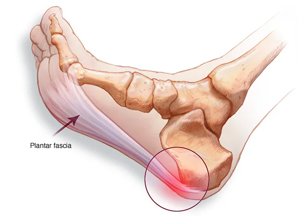 Plantar fasciitis is a common foot condition 